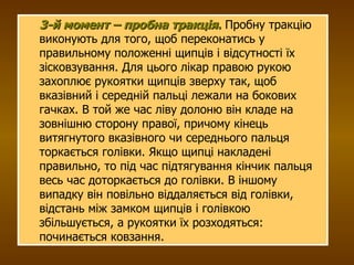 3-й момент – пробна тракція .  Пробну тракцію виконують для того, щоб переконатись у правильному положенні щипців і відсутності їх зісковзування. Для цього лікар правою рукою захоплює рукоятки щипців зверху так, щоб вказівний і середній пальці лежали на бокових гачках. В той же час ліву долоню він кладе на зовнішню сторону правої, причому кінець витягнутого вказівного чи середнього пальця торкається голівки. Якщо щипці накладені правильно, то під час підтягування кінчик пальця весь час доторкається до голівки. В іншому випадку він повільно віддаляється від голівки, відстань між замком щипців і голівкою збільшується, а рукоятки їх розходяться: починається ковзання. 