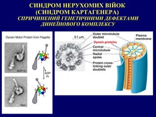 СИНДРОМ НЕРУХОМИХ ВІЙОК  (СИНДРОМ КАРТАГЕНЕРА)  СПРИЧИНЕНИЙ ГЕНЕТИЧНИМИ ДЕФЕКТАМИ ДИНЕЇНОВОГО КОМПЛЕКСУ 