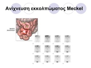Ανίχνευση εκκολπώματος  Meckel 