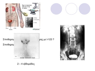 Σπινθηρογράφημα & δοκ. πρόσληψης με Ι-123   ? Σπινθηρογράφημα με  TcO4 ?   2 – 4  εβδομάδες 