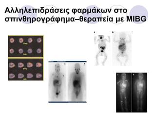 Αλληλεπιδράσεις φαρμάκων στο σπινθηρογράφημα–θεραπεία με  MIBG 