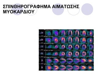 ΣΠΙΝΘΗΡΟΓΡΑΦΗΜΑ  AIM ΑΤΩΣΗΣ   ΜΥΟΚΑΡΔΙΟΥ 
