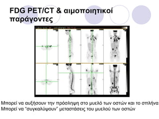 FDG PET/CT &  αιμοποιητικοί παράγοντες Μπορεί να αυξήσουν την πρόσληψη στο μυελό των οστών και το σπλήνα Μπορεί να  “ συγκαλύψουν ”  μεταστάσεις του μυελού των οστών 