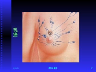 12/06/11 陳旺全醫師 乳癌 