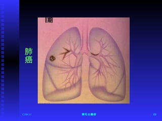 12/06/11 陳旺全醫師 肺癌 