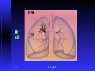 12/06/11 陳旺全醫師 肺癌 
