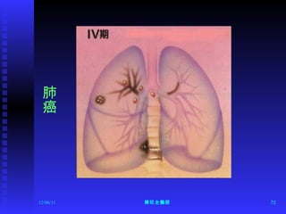 12/06/11 陳旺全醫師 肺癌 