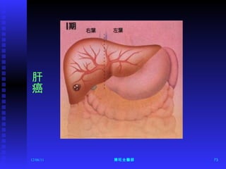12/06/11 陳旺全醫師 肝癌 