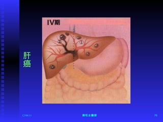 12/06/11 陳旺全醫師 肝癌 