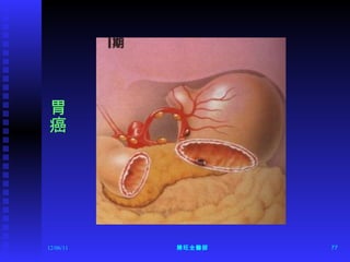 12/06/11 陳旺全醫師 胃癌 
