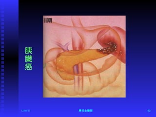 12/06/11 陳旺全醫師 胰臟癌 