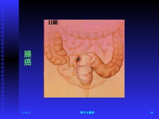 12/06/11 陳旺全醫師 腸癌 