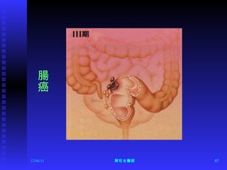 12/06/11 陳旺全醫師 腸癌 