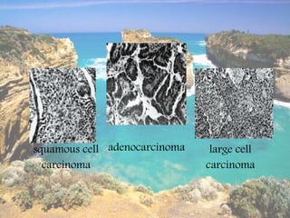 2. Small cell carcinoma หรื อที่เรี ยก oat cell cancer
พบน้อยแต่แพร่ กระจายเร็ ว



  การรักษา non-small cell lung cancer
...
