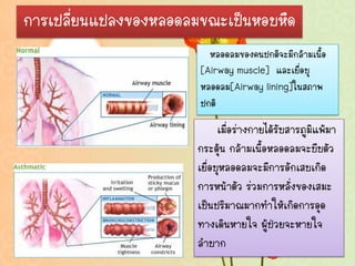 การเปลี่ยนแปลงของหลอดลมขณะเป็นหอบหืด
                         หลอดลมของคนปกติจะมีกล้ามเนื้อ
                       [Airway muscle] และเยื่อบุ
                       หลอดลม[Airway lining]ในสภาพ
                       ปกติ
                             เมื่อร่างกายได้รับสารภูมิแพ้มา
                       กระตุ้น กล้ามเนื้อหลอดลมจะบีบตัว
                       เยื่อบุหลอดลมจะมีการอักเสบเกิด
                       การหน้าตัว ร่วมการหลังของเสมะ
                                                ่
                       เป็นปริมาณมากทาให้เกิดการอุด
                       ทางเดินหายใจ ผู้ป่วยจะหายใจ
                       ลาบาก
 