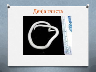 Дечја глиста
 