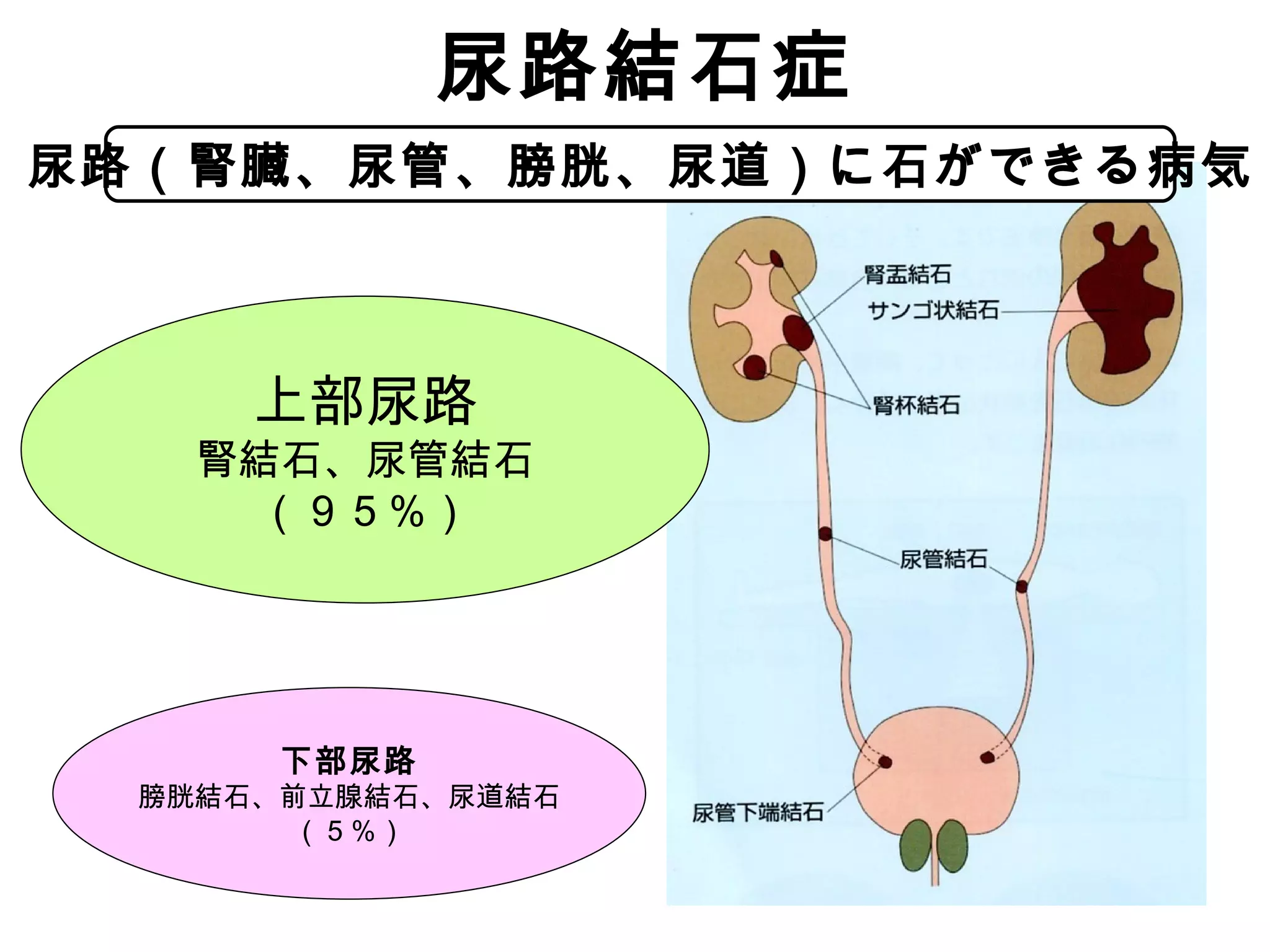 尿路結石の症状､ガイドライン | PPT