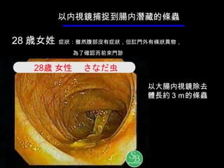28 歳 女姓   症 狀 ： 雖然腹部沒有症狀，但肛門外有條 狀 異物， 為了確認而前來門診 以 内 視鏡捕捉到腸 内 潛藏的條蟲 以大腸 内 視鏡除去體長約 ３ｍ 的條蟲 