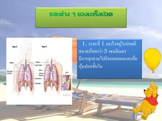 ่
   1. ระยะที่ 1 มะเร็ งอยูในปอดมี
ขนาดน้อยกว่า 3 เซนติเมตร
มีการลุกลามไปยังหลอดลมและเยือ   ่
หุ มปอดชั้นใน
   ้
 