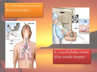 5. การส่ องกล้องผ่านทางหลอดลม
(Bronchoscope)




                                6. การเจาะชิ้นเนื้อเพื่อการวินิจฉัย
                                (Fine needle biopsy)
 