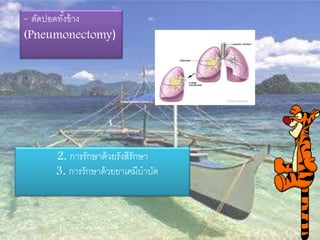 - ตัดปอดทังข้ าง
          ้
(Pneumonectomy)




     2. การรักษาด้ วยรังสีรักษา
     3. การรักษาด้ วยยาเคมีบาบัด
 