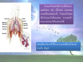 โรคมะเร็ งปอดเป็ นโรคที่เกิดจาก
   เซลล์ปอด เช่น เนื้อปอด หลอดลม
   กลายเป็ นเซลล์มะเร็ ง โรคมะเร็ งปอด
   เป็ นโรคมะเร็ งที่พบบ่อย หากพบเร็ ว
   สามารถรักษาให้หายขาดได้




ปอดเป็ นอวัยวะที่ใช้ในการแลกเปลี่ยนก๊าซและ
หายใจ ดังรู ป
 