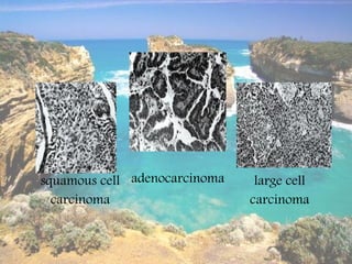 squamous cell adenocarcinoma    large cell
  carcinoma                    carcinoma
 