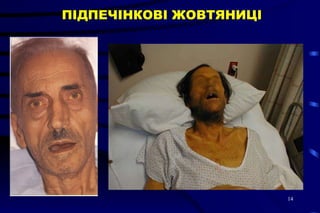 ПІДПЕЧІНКОВІ ЖОВТЯНИЦІ 