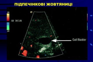 ПІДПЕЧІНКОВІ ЖОВТЯНИЦІ 