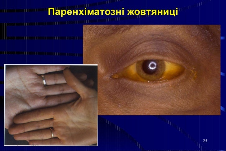 жовтяниці