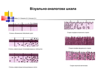 Норма Слабая (1+) Средняя (2+) Сильная (3+)  Степень обсеменения Helicobacter рylori  Степень инфильтрации полиморфноядерных лейкоцитов  Степень инфильтрации мононуклеарных клеток  Стадия атрофии антрального отдела  Стадия атрофии фундального отдела  Стадия кишечной метаплазии Візуально-аналогова шкала 