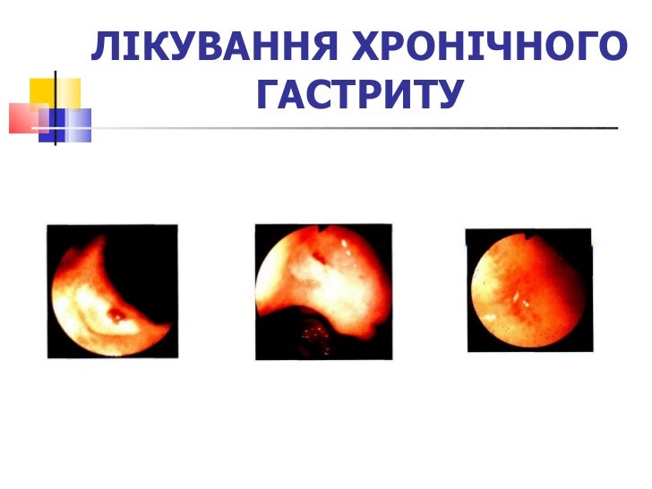 хронічний гастрит