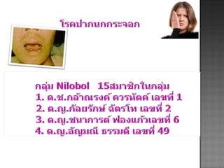 โรคปากนกกระจอก Nilobol 15