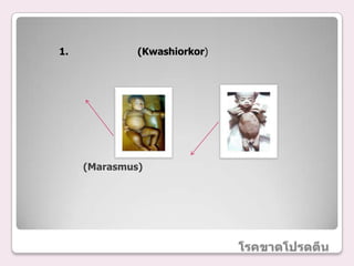 1.            (Kwashiorkor)




     (Marasmus)
 