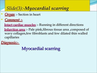 Slide(3):- Myocardial scarring   Organ   :- Section in heart Comment :- Intact cardiac muscles  :- Running in different directions Infarction area  :- Pale pink,fibrous tissue area ,composed of wavy collagen,few fibroblasts and few dilated thin walled capillaries Diagnosis:-  Myocardial scarring  