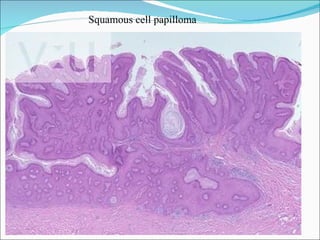 Squamous cell papilloma 