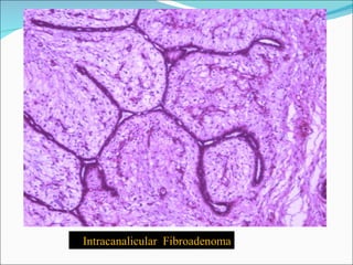 Intracanalicular  Fibroadenoma  