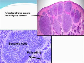 Basaloid cells  Palisading  Retracted stroma  around the malignant masses  