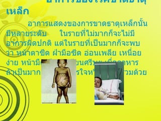   อาการของโรคขาดธาตุเหล็ก   อาการแสดงของการขาดธาตุเหล็กนั้นมีหลายระดับ  ในรายที่ไม่มากก็จะไม่มีอาการผิดปกติ แต่ในรายที่เป็นมากก็จะพบว่า หน้าตาซีด ฝ่ามือซีด อ่อนเพลีย เหนื่อยง่าย หน้ามืด มึนงง เวียนศรีษะ เบื่ออาหาร ถ้าเป็นมากอาจมีอาการใจหวิว ใจสั่นร่วมด้วย 