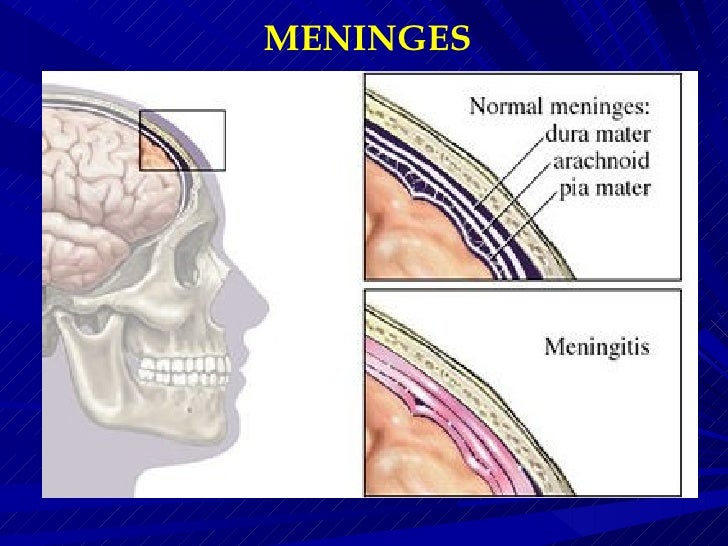 meningitis case study slideshare