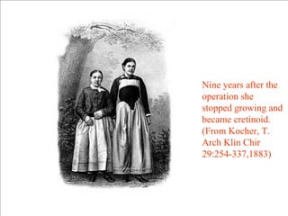Nine years after the
operation she
stopped growing and
became cretinoid.
(From Kocher, T.
Arch Klin Chir
29:254-337,1883)
 