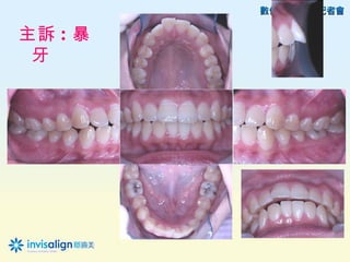 主訴 : 暴
 牙
 