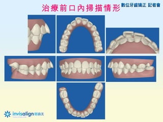 治療前口內掃描情形
 
