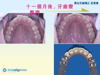 十一個月後 , 牙齒變
 整齊
 