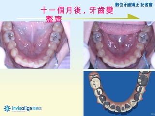十一個月後 , 牙齒變
 整齊
 