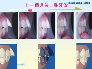 十一個月後 , 暴牙改
 善
 