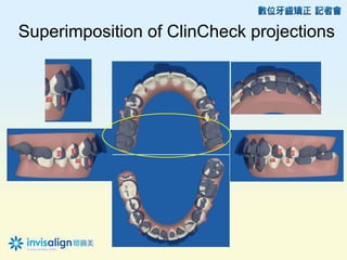 Superimposition of ClinCheck projections
 