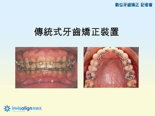 傳統式牙齒矯正裝置
 