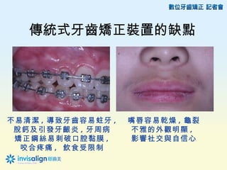 傳統式牙齒矯正裝置的缺點




不易清潔 , 導致牙齒容易蛀牙 ,   嘴唇容易乾燥 , 龜裂
 脫鈣及引發牙齦炎 , 牙周病     不雅的外觀明顯 ,
 矯正鋼絲易刺破口腔黏膜 ,      影響社交與自信心
  咬合疼痛 , 飲食受限制
 