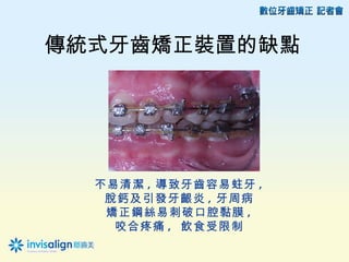 傳統式牙齒矯正裝置的缺點




  不易清潔 , 導致牙齒容易蛀牙 ,
   脫鈣及引發牙齦炎 , 牙周病
   矯正鋼絲易刺破口腔黏膜 ,
    咬合疼痛 , 飲食受限制
 